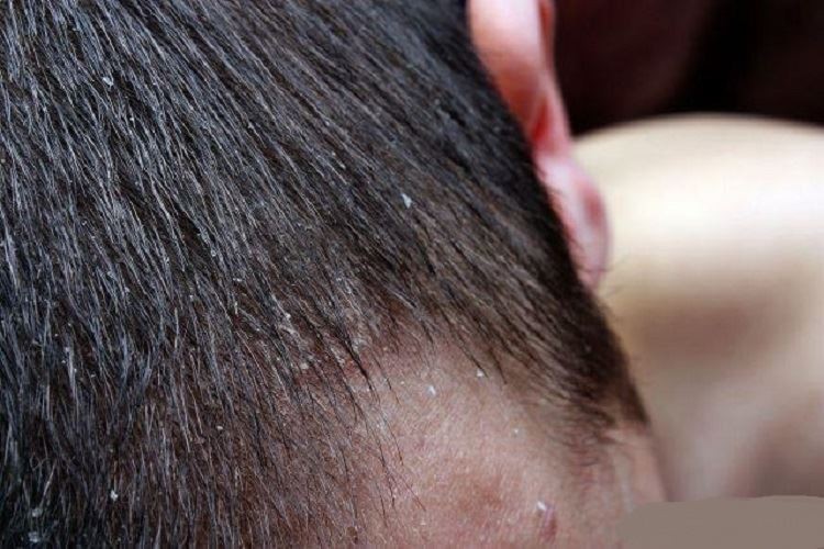 Type of dandruff (1)